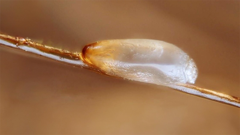 photo of head lice egg