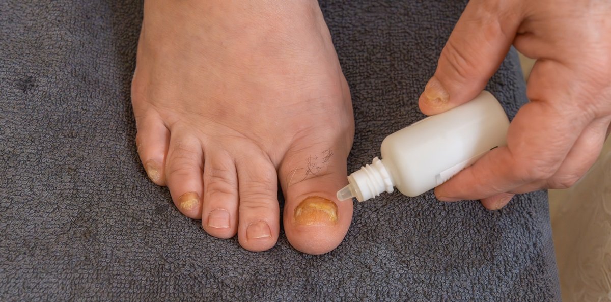 Essential Oils for Onychomycosis