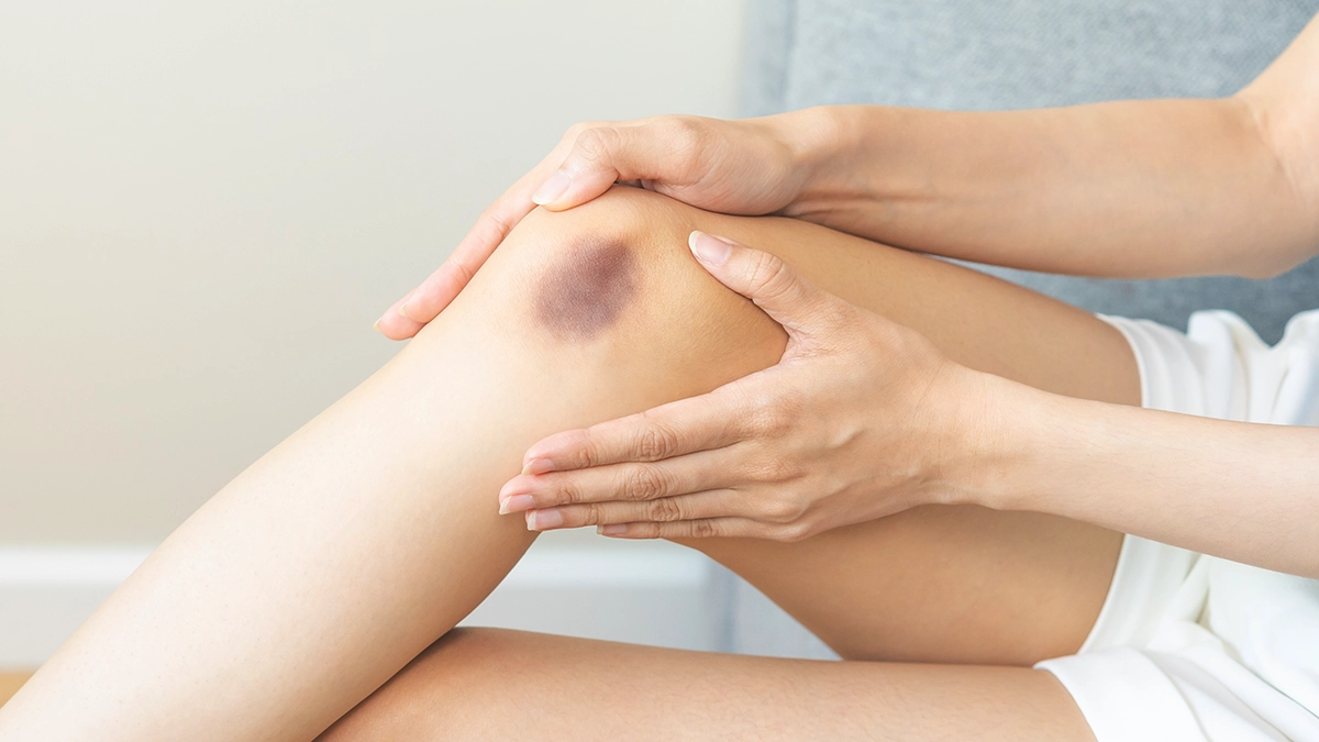 A person holding their bruised knee Healing Process